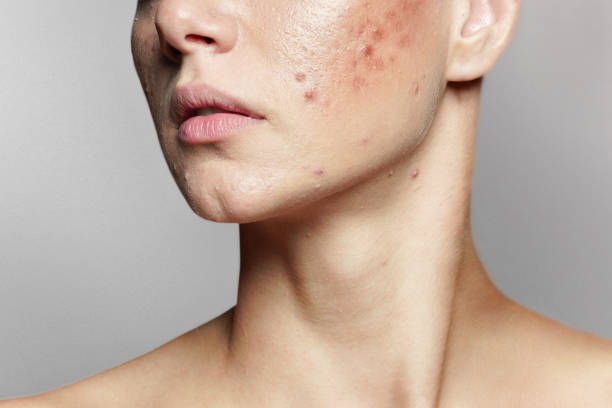 What Are The Different Types Of Acne Treatments?